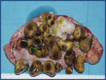 Pedra na Ves cula Biliar e seus inc modos Cirurgia de H rnia e